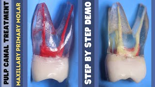 Pulp Canal Treatment 🟡 Maxillary Primary Molar 🔵 step by step demonstration [upl. by Yager124]