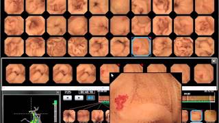 WEO Video Capsule Endoscopy VCE Library clinical case 51 [upl. by Felicity]