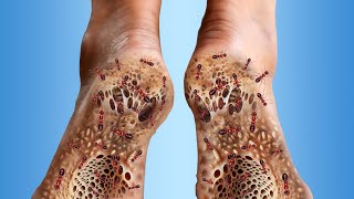 ASMR Animation treatment from infected Heel  ASMR Treatment Animation  2D Animation 073 [upl. by Jacquetta]