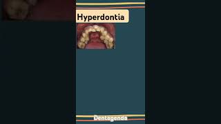 Hyperdontia [upl. by Reggy]