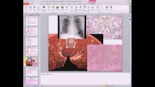 Medical School Pathology 2013 Season Session 47 HeartI [upl. by Catina]