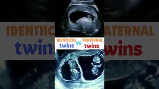 Identical v Fraternal twins  identify baby pregnancy ultrasound shorts [upl. by Wieche155]