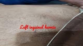 Left inguinal hernia anatomy viral video abnormal ultrasound [upl. by Aihseyt]