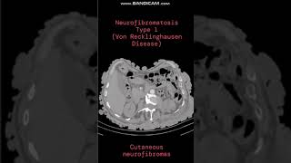 NEUROFIBROMATOSIS TYPE I VON RECKLINGHAUSEN DISEASE A new case every daySame time tomorrow [upl. by Kylah781]