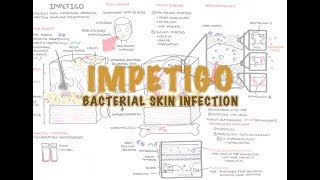 Impetigo Bacterial Skin Infection  Overview Clinical Presentation Pathophysiology Treatment [upl. by Hibbitts430]