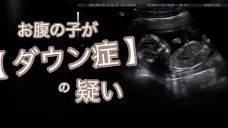 【ダウン症告知】お腹の中の子がダウン症の疑い【妊娠 エコー】 [upl. by Niatsirk]