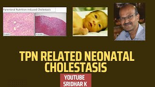 TPN related cholestasis neonatalcholestasis preterm TPN [upl. by Drannek]