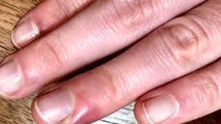 What is PARONYCHIA  Finger nail infection  Solve Paronychia with these simple Home Remedies [upl. by Ttayh13]