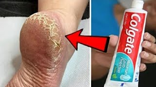 Eliminate Cracked Heels and Get White Smooth Feet  Cracked Heels Home Remedy [upl. by Sadnac]