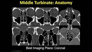 New update  imaging of Paranasal sinuses and anterior skull base [upl. by Umont]