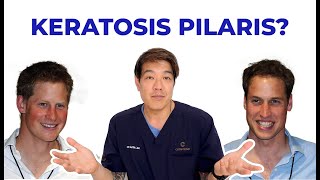 Keratosis Pilaris  How to treat by dermatologist Dr Davin Lim [upl. by Riccardo]