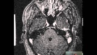 Mastoiditis Brain Abscess DISCUSSION [upl. by Merl]