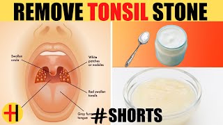 Powerful Home Remedies for Tonsil Stones That Work Fast  Tonsilloliths SHORTS [upl. by Dafodil]