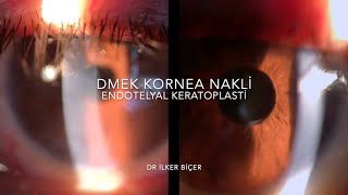 DMEK Kornea Endotel Nakli [upl. by Ignazio]