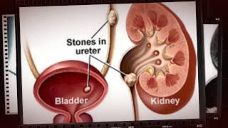 renal calculi symptoms and causes [upl. by Ydnal57]