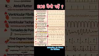 ECG Report  How To Read ECG  Abnormal ECG  Normal ECG 10millionviews trending ytshorts [upl. by Whitten]