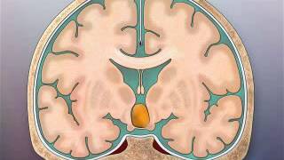 Transcallosal TC Surgical Approach to Hypothalamic Hamartomas [upl. by Niliac]