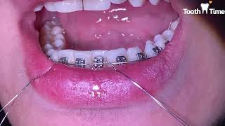 Hybrid orthodontic treatment Video  2 Braces amp Clear Aligners together  Tooth Time Family Braces [upl. by Sirahs]