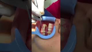 Colmillos de vampiro halloween disfraz dientes colmillo viralvideo shorts dentist vampire [upl. by Crespi254]