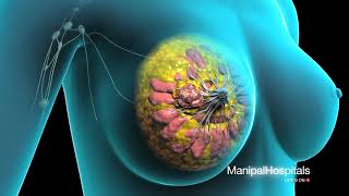 Surgical Procedure For Breast Removal  Lumpectomy Surgery  Mastectomy  Manipal Hospital [upl. by Ailic]