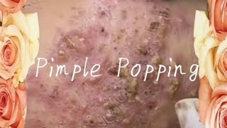 Pimple amp Blackheads Popping  8 [upl. by Clarisse958]