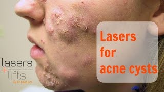 Treating acne cysts [upl. by Davy119]