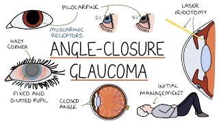 Understanding Acute Angle Closure Glaucoma [upl. by Bonne]