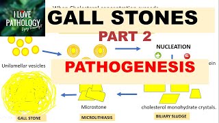 CHOLELITHIASIS GALL STONESPart 2 Pathogenesis Morphology Clinical FeaturesComplications [upl. by Idnor]