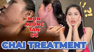 Mình đã trị sạch mụn nổi xuống tận cổ khi bị CHAI TREATMENT như thế nào ❗❓ [upl. by Alodee369]