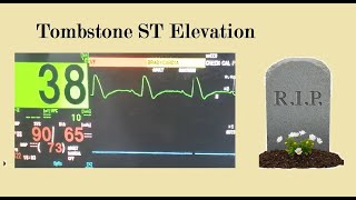 STEMI  Tombstone ST elevation [upl. by Evannia]