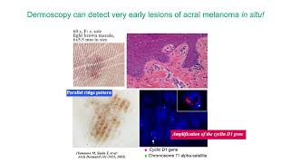 3 Step Algorithm for Acral Melanocytic Lesions  Dr Toshiaki Saida [upl. by Idyh]