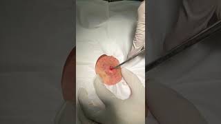 Minimally Invasive Cyst Removal [upl. by Anitra58]