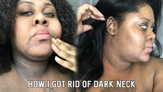 HOW I LIGHTEND MY DARK NECK Serious [upl. by Jarid]