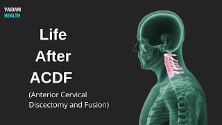 Life After ACDF Anterior Cervical Discectomy and Fusion [upl. by Enneles]