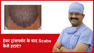 How To Remove Scabs After Hair Transplant हेयर ट्रांसप्लांट के बाद scabs कैसे हटाएं  HairMD Pune [upl. by Gnourt250]