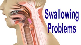 Swallowing Problems or Dysphagia Top 4 Possible Causes Including Cricopharyngeal Dysfunction CPD [upl. by Itsim]