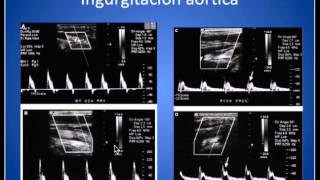 Analisis Onda Espectral Arterias Carótidas y Vertebrales [upl. by Monreal]