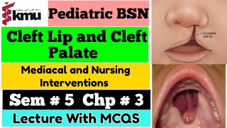 Cleft Lip and Cleft Palate  Pediatric Health NursingChap  3  BSN Sem 5th With MCQS Farman KMU [upl. by Nocaed566]