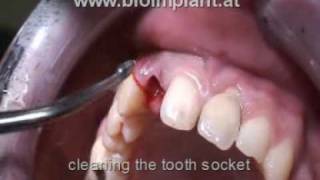 IMMEDIATE IMPLANT  INCISOR  NO DRILLING  FLAPLESS  LIVE VIDEO [upl. by Onimod]