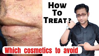 Perioral dermatitis  Cosmetics induced  Diagnosis amp treatment  Hindi [upl. by Itoc149]