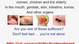 Easy Yeast Infection Treatment Home Remedy [upl. by Hayyikaz]