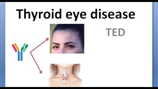 Ophthalmology 423 Thyroid Eye Disease Graves Exophthalmos Proptosis NOSPECS Classification Cause [upl. by Butcher]