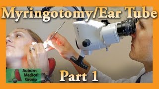 Myringotomy amp Ear Tube Part 1 Feat Dr Tim Fife  Myringotomy  Auburn Medical Group [upl. by Sonahpets]