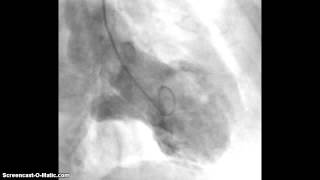 Takotsubo Cardiomyopathy LV Angiography [upl. by Ipoillak609]