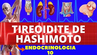 TIREOIDITE DE HASHIMOTO CAUSAS SINTOMAS DIAGNÓSTICO E TRATAMENTO  ENDOCRINOLOGIA [upl. by Shanon88]