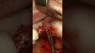 Transalveolar Sinus Elevation and Roll Flap Technique [upl. by Amador]