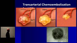 Hepatocellular Carcinoma Optimal Treatment and Transplantation [upl. by Bierman]