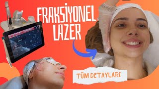 FRAKSİYONEL LAZER YAPTIRDIM TÜM detayları  CO2 fractional laser [upl. by Shakti]