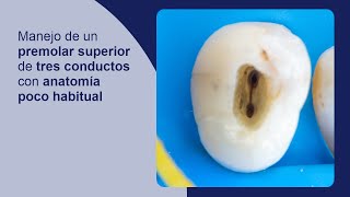 Manejo de un premolar superior de tres conductos con anatomía poco habitual [upl. by Ennairrek585]