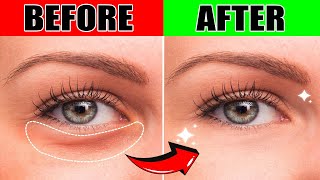 How To Remove Eye Bags 20 Minute Natural Remedies  Golden Nutrition [upl. by Flossy]